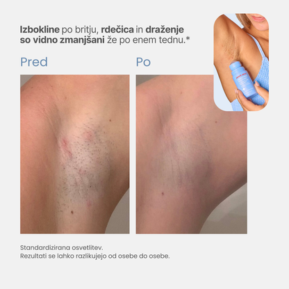 Roll-on proti vraščenim dlakam in izboklinam