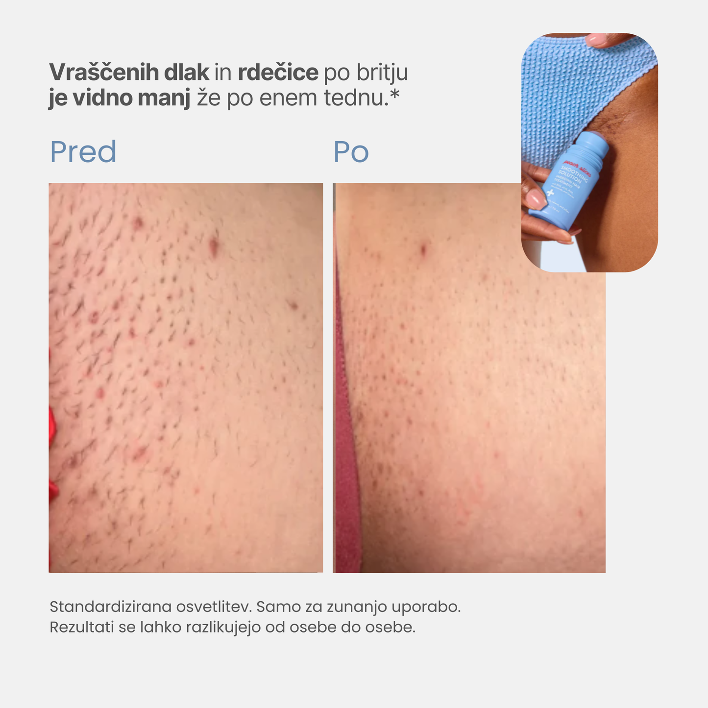 Roll-on proti vraščenim dlakam in izboklinam