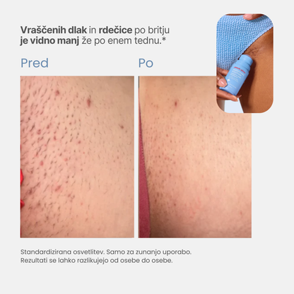 Roll-on proti vraščenim dlakam in izboklinam