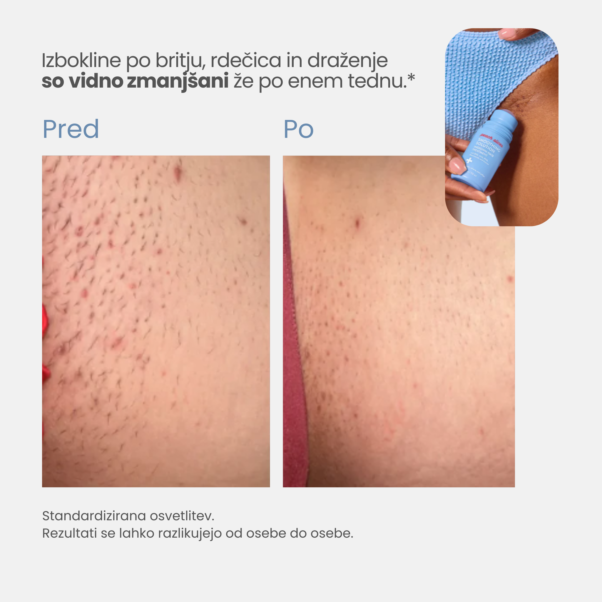 Smooth Slices® Roll-on proti vraščenim dlakam in izboklinam