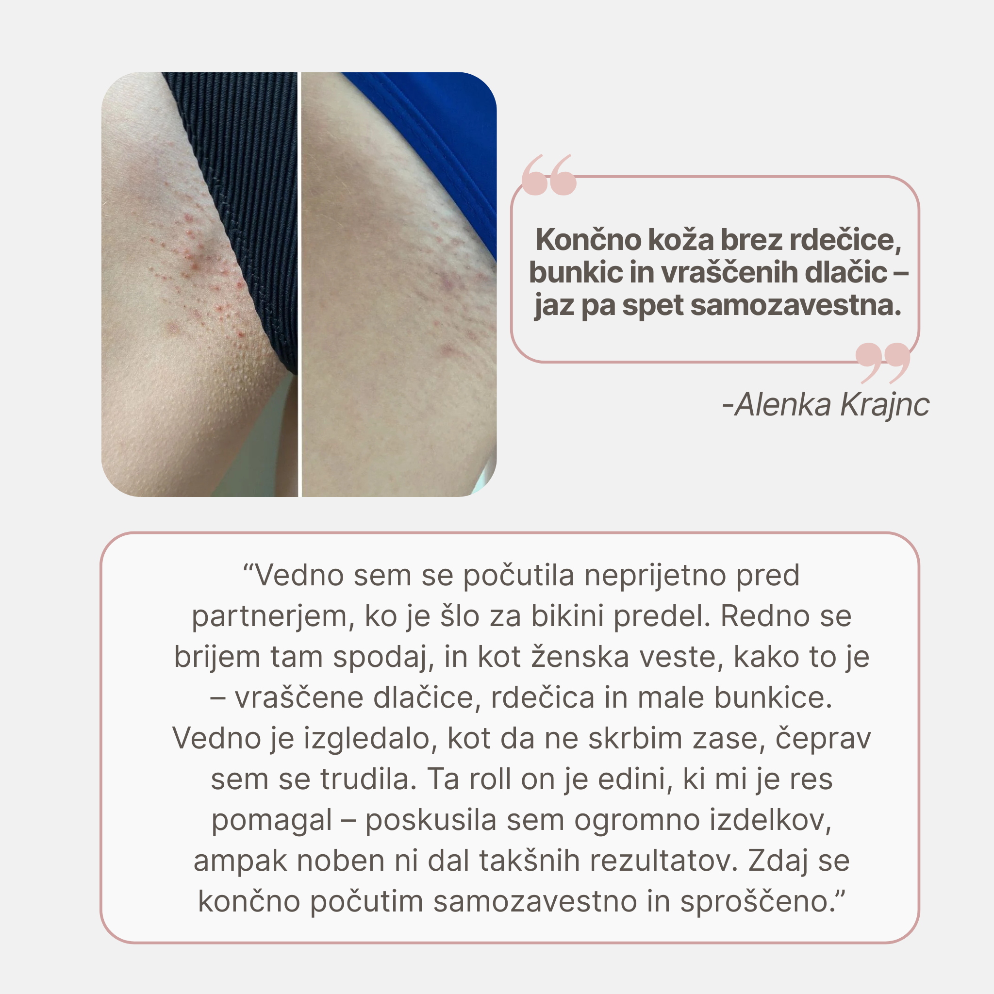 Smooth Slices® Roll-on proti vraščenim dlakam in izboklinam