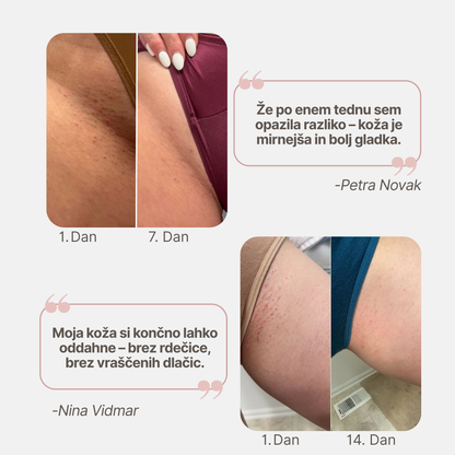 Roll-on proti vraščenim dlakam in izboklinam