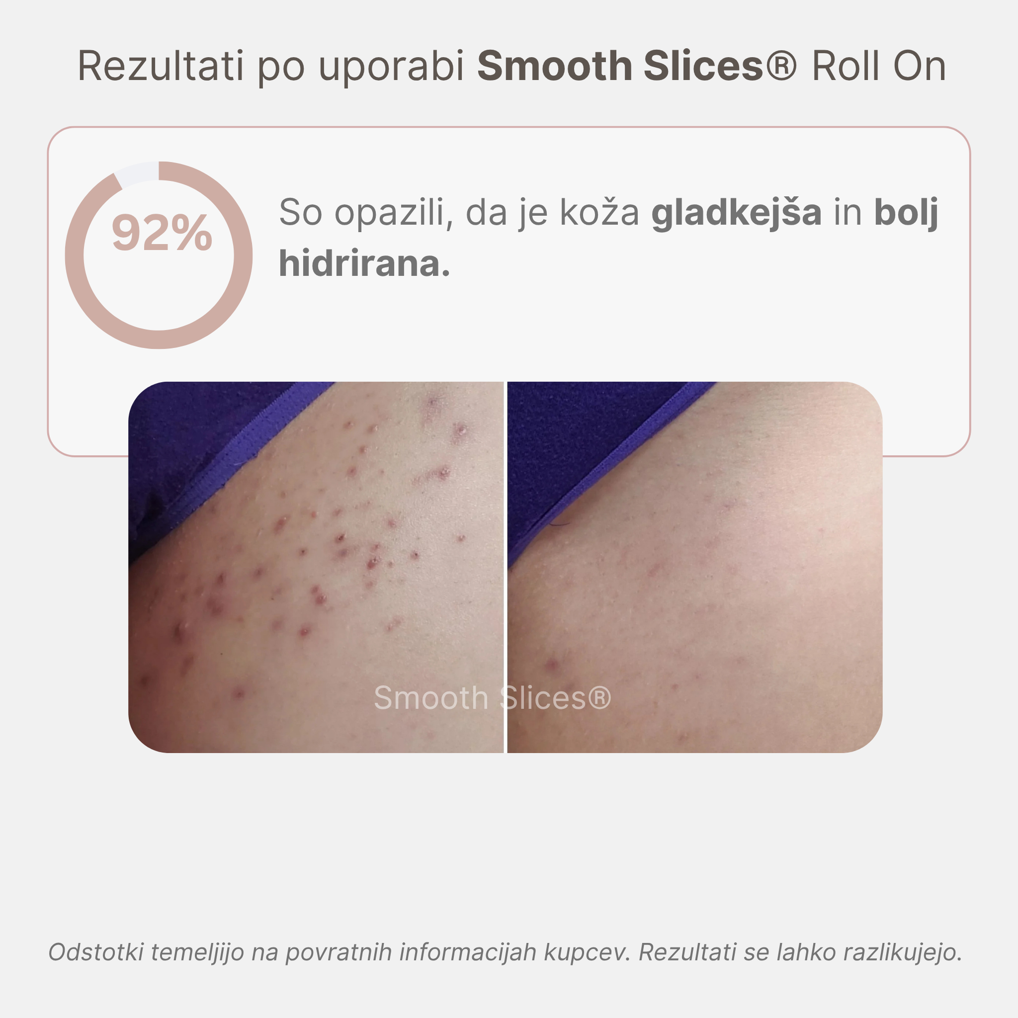 Smooth Slices® Roll-on proti vraščenim dlakam in izboklinam