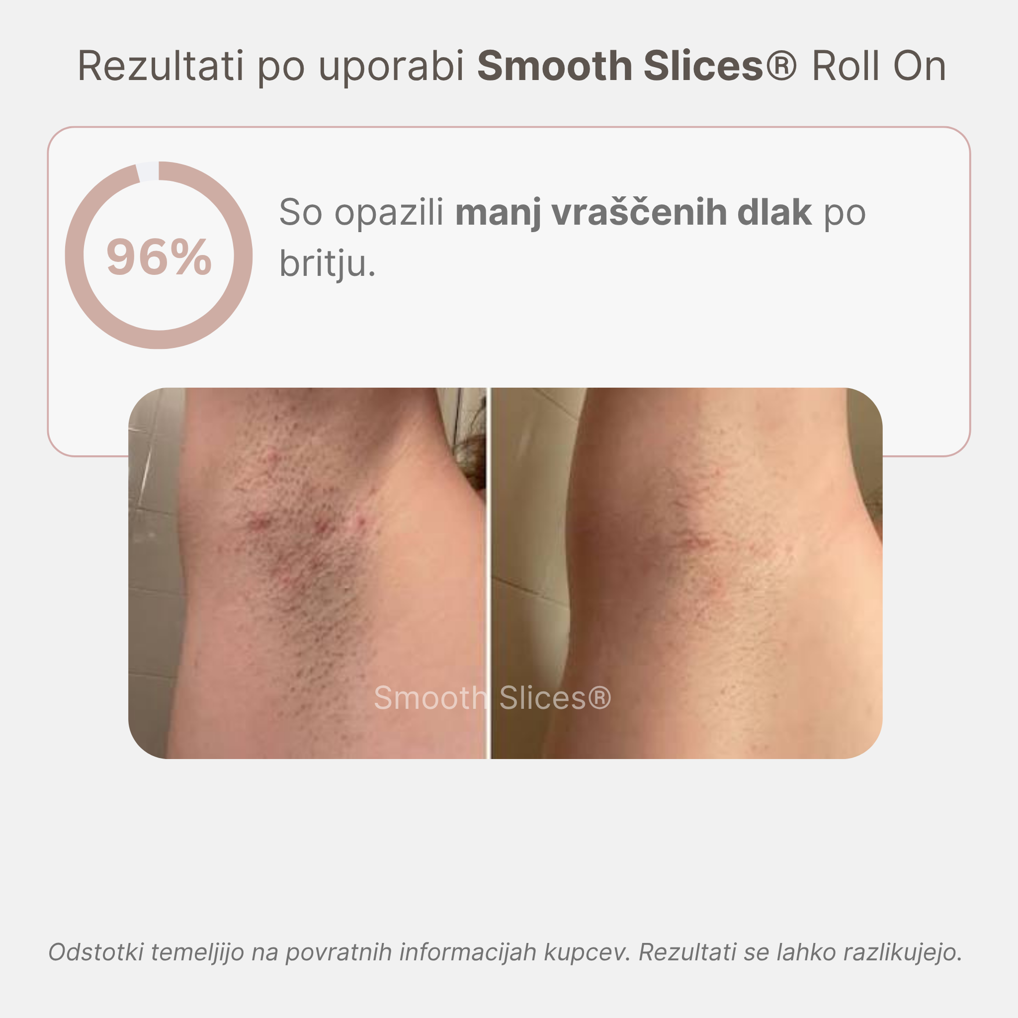 Smooth Slices® Roll-on proti vraščenim dlakam in izboklinam