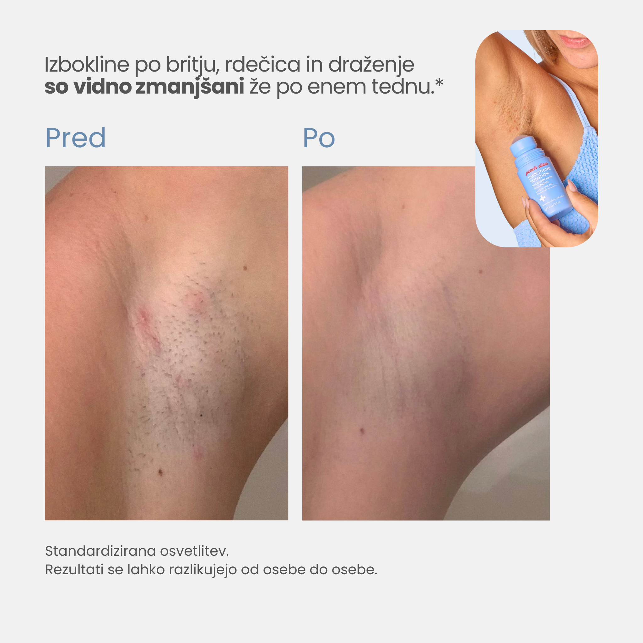 Smooth Slices® Roll-on proti vraščenim dlakam in izboklinam